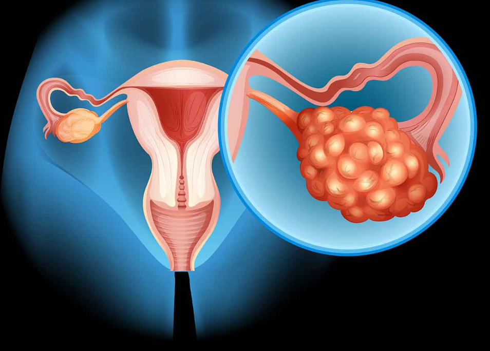 diagrama de utero con sop