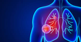 animación pulmones con neumonía