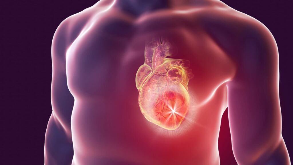 animación que representa la angina de pecho